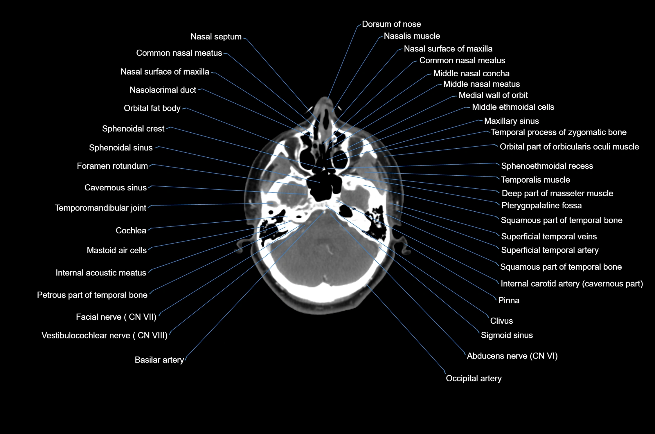 CT Neck axial cross sectional anatomy radiology image-img-00001-00012.webp